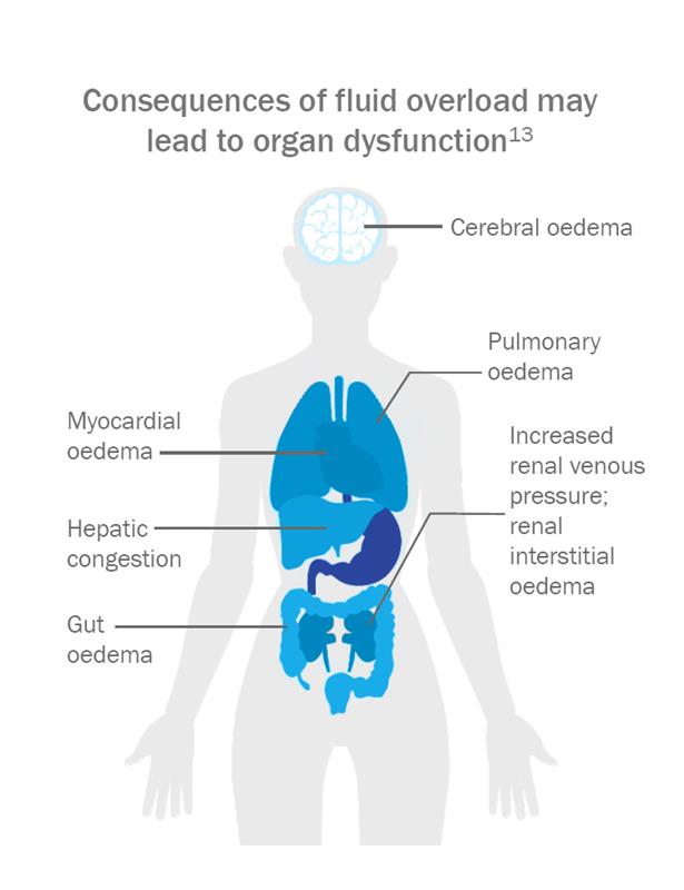 Image of a human body, showing how the Consequences of Fluid Overload May Lead to Organ Dysfunction. Head - Cerebral oedema, lungs - pulmonary oedema, heart - myocardial oedema, liver - hepatic congestion, large intestine -  gut oedema, kidneys - increased renal venous pressure; renal interstitial oedema.